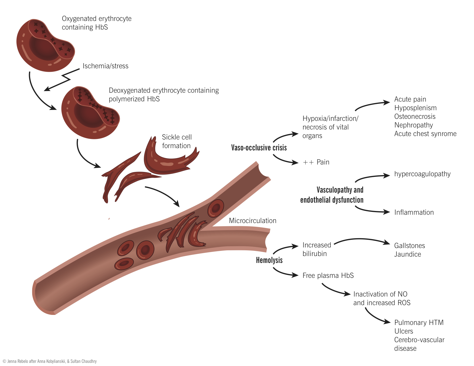 sickle cell disease (scd) | mcmaster pathophysiology review