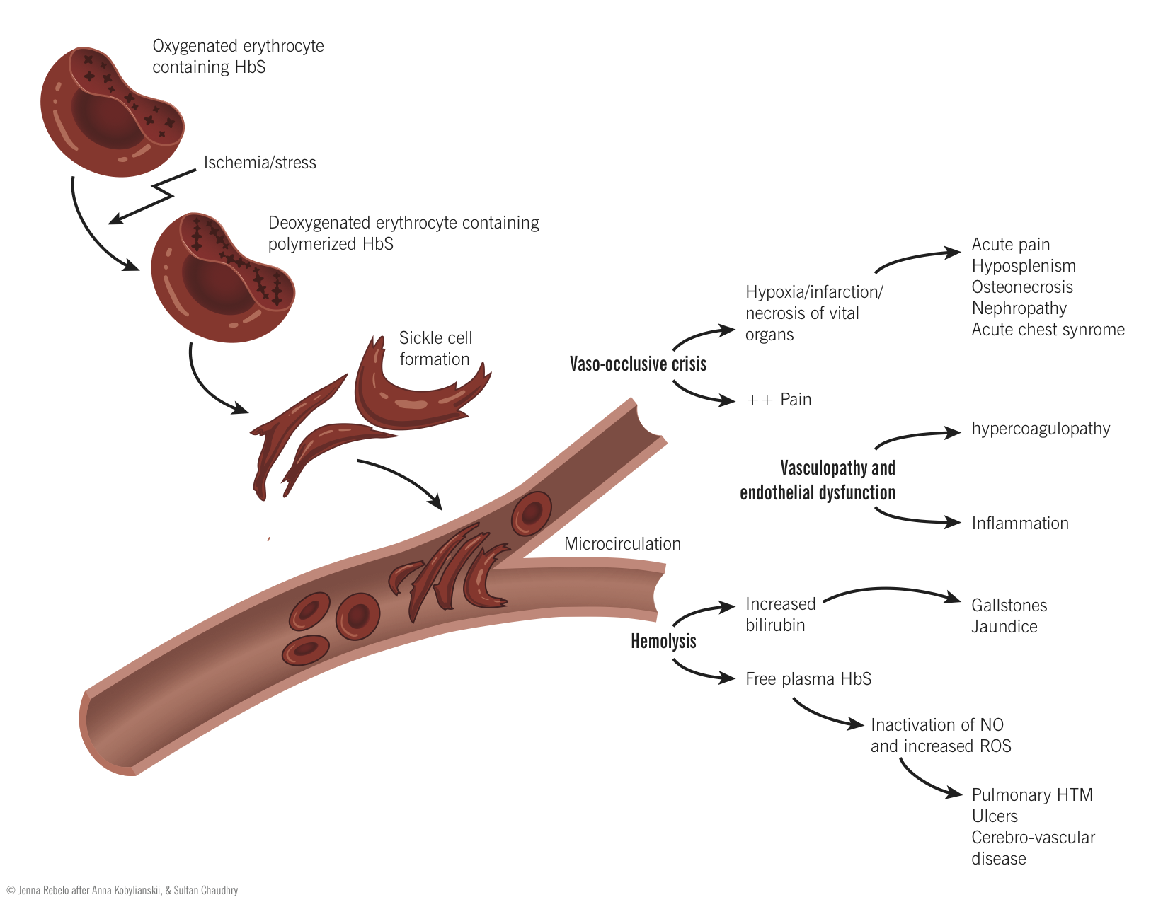 Pathophysiology of sickle cell disease