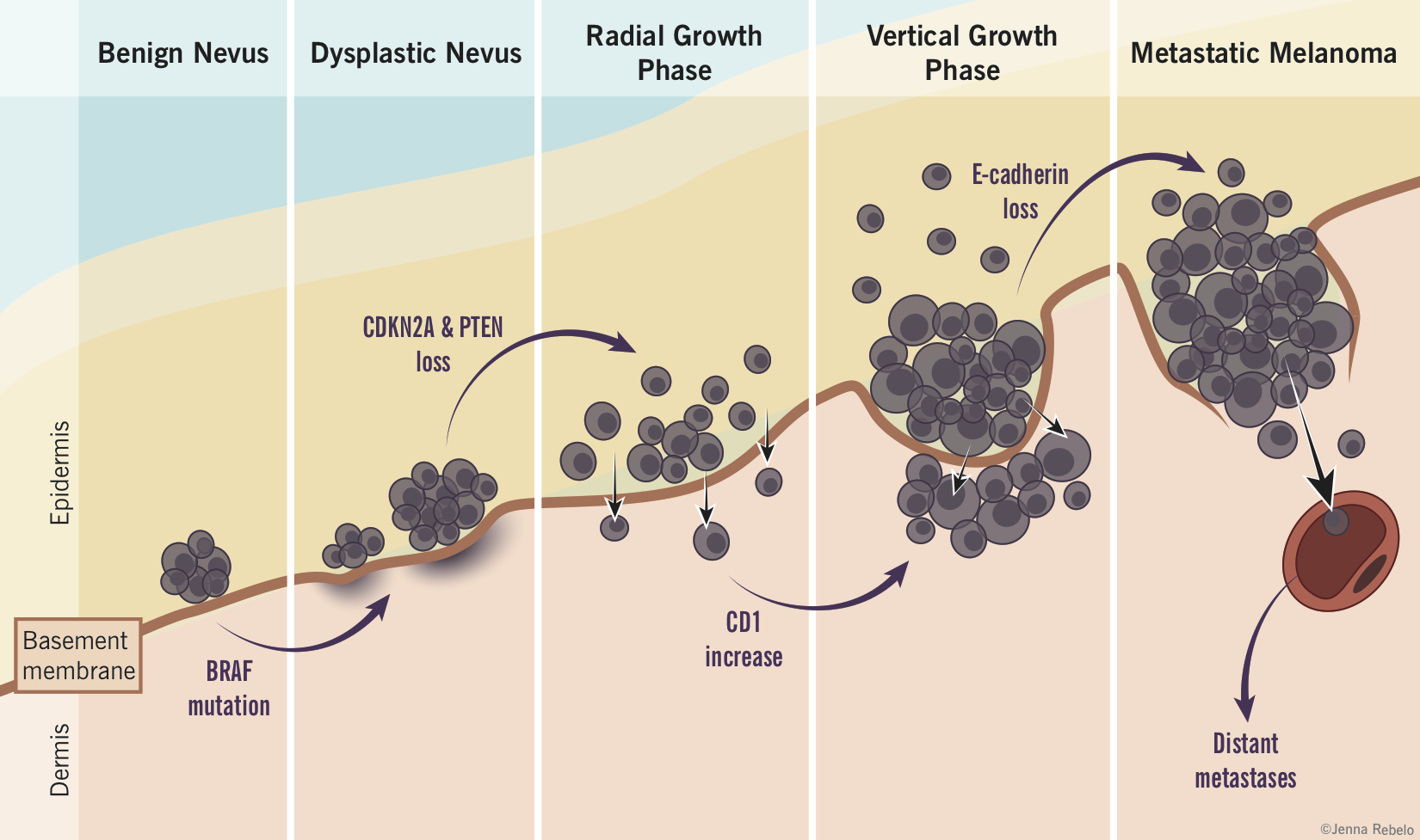 Melanoma progression